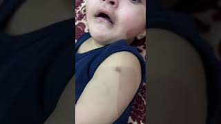 Papule, Pustule, Ulcer And Scar  Consider Evidence Of Successful Vaccination