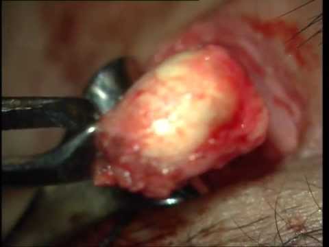 cyst eyelid dermoid eye pimple pus lots deep popping jacob soosan lid