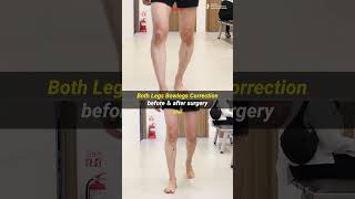 [before ＆ after] Bowlegs Correction