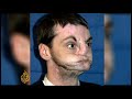 US man undergoes full face transplant