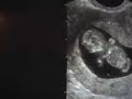 Dancing Ultrasound Baby