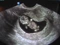 Dancing Ultrasound Baby