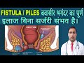FISTULA / PILES || बवासीर भगंदर का पूर्ण इलाज बिना सर्जरी संभव है। || Dr Kumar education clinic