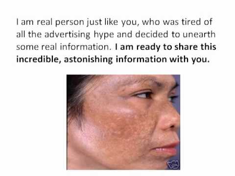 Melasma Treatment - How To Get Rid of Hyperpigmentation ...