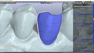 Making a no-prep veneer for tooth 23