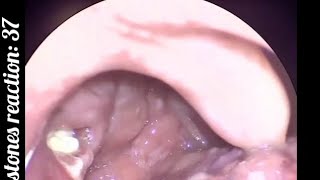 Tonsil Stones Reaction 37 Tonsilloliths Are Not The Same As Tonsillitis.
