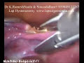 Laparoscopy Hysterectomy TLH LAVH Video (Lap Uterus Removal