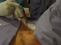 DISCOLISIS CERVICAL