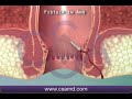 PERIANAL ABSCESS