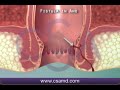 PERIANAL ABSCESS