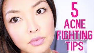 HOW TO: Get Rid of Acne Scars & Pimples!
