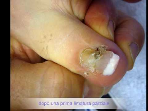 Come liberarsi da rimedi di gente di fungo di piede