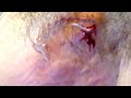 HUGE ABSCESS STAPH INFECTION POPPED IN ARMPIT   HUGE PLUG REMOVED   BEST ABSCESS DRAINAGE EVER!!!!