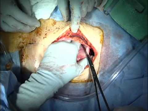 Play: Total Abdominal Hysterectomy: Fibroid Uterus