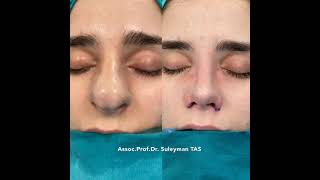 Closed Rhinoplasty 7 Days After