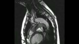 Cardiac Mri - Pulmonary Artery With Patent Ductus