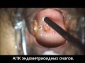 Эндометриоз шейки матки и цервикального канала.АПК.