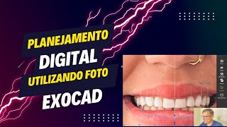 Planejamento Digital No Exocad Utilizando A Foto Do Paciente.