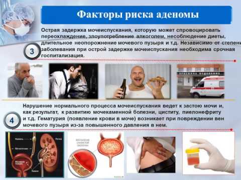 Аденома соска что это Аденома соска что это