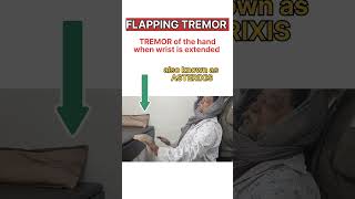 Flapping Tremor Asterixis Negative Myoclonus