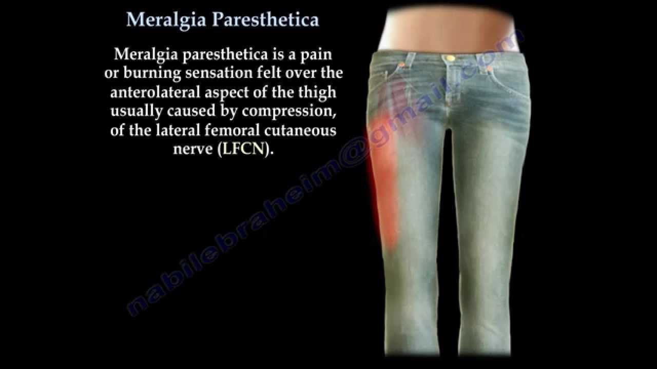 Meralgia Paresthetica - Everything You Need To Know - Dr. Nabil