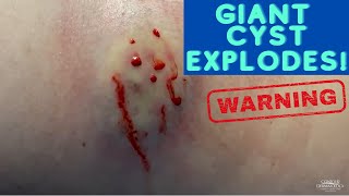 Watch This Giant Cyst SQUIRT! 😲