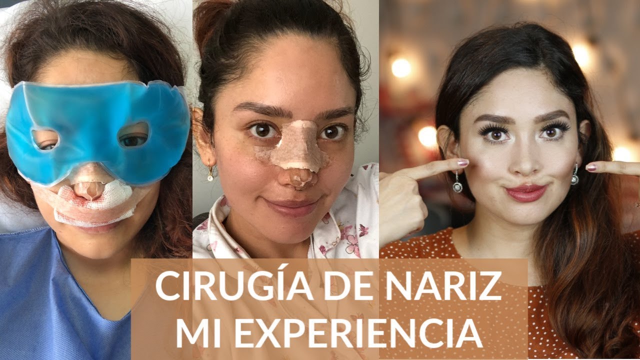 I OPERATED MY NOSE! | FUNCTIONAL AND AESTHETIC SURGERY | MICH ECUADOR I OPERATED MY NOSE! | FUNCTIONAL AND AESTHETIC SURGERY | MICH ECUADOR