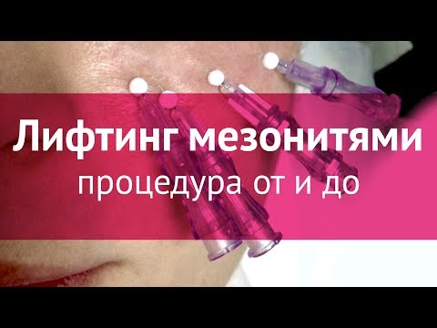 Подтяжка лица мезонитями: процедура от и до Подтяжка лица мезонитями: процедура от и до