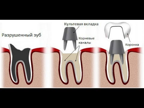 Культевые вкладки для восстановления зуба Культевые вкладки для восстановления зуба
