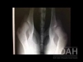 Triple Pelvic Osteotomy