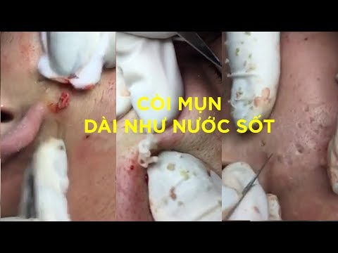 5 Mụn mũ dài như sợi chỉ THÍCH NẶN MỤN