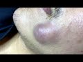 Big Pimples | Mụn Nhọt Siêu To - SacDepSpa#158