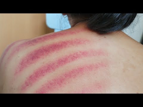 PADA NUNGGUIN KEROKAN||MASUK ANGIN KASEP||HASILNYA MERAH BANGET