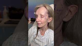 Before And One Month After Facelift Surgery With Dr. Madnani