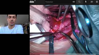 CIRURGIA NARRADA (react): COARCTAÇÃO DA AORTA