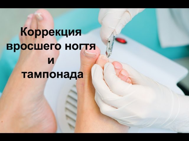 Как правильно делать педикюр при вросшем ногте Как правильно делать педикюр при вросшем ногте