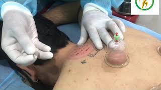 what we got into #cupping #hijama? Worth to watch,what is cupping? #benefits for skin care & #pain