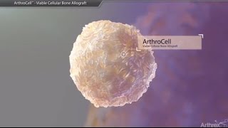 Arthrocell Viable Cellular Bone Allograft