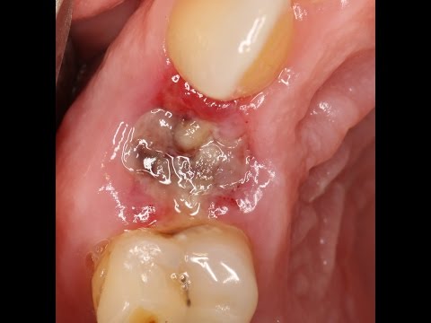 0 - Запах з рота після видалення зуба: причини, лікування запалення полосканням