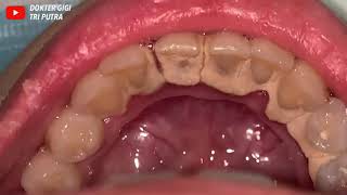 21 Yo Females Teeth Tartar Removal Scaling Dentist Dokter Gigi Tri Putra