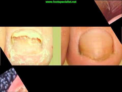 nail fungus laser treatment, NJ. Laser treatment for fungus nails is now FDA
