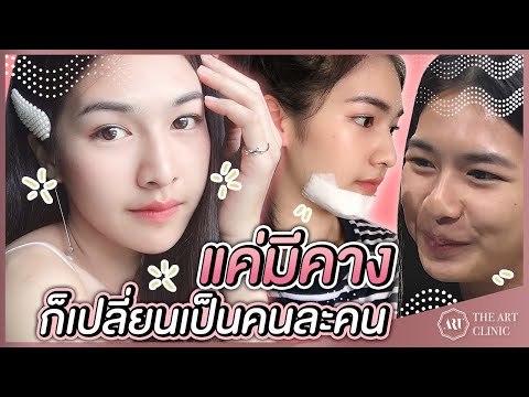 VLOG เสริมคาง : สาวคางสั้นหน้ากลม อยากหน้าสวยต้องดู :The Art Clinic