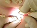 PERIANAL ABSCESS