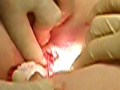 PERIANAL ABSCESS