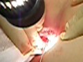 PERIANAL ABSCESS
