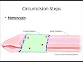 adult circumcision