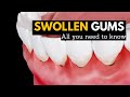 Swollen Gums Explained: What You Need to Know and How to Treat Them