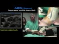 Ultrasound guided interscalene brachial plexus block