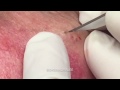 Four blackheads extracted. Your weekend fix! Enjoy!