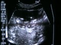 Twin Ultrasound at 12 Weeks! Genders???